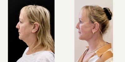 Neck Lift before and after photo