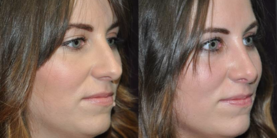 Rhinoplasty before and after photo