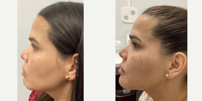 Chin Filler before and after photo