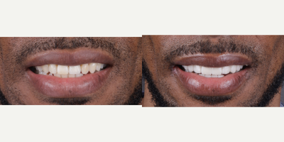 Dental Implants before and after photo
