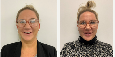 Dermal Fillers before and after photo