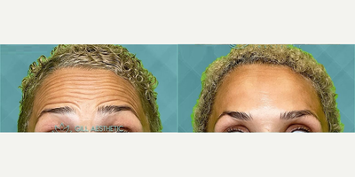 Botox before and after photo