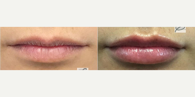Dermal Fillers before and after photo