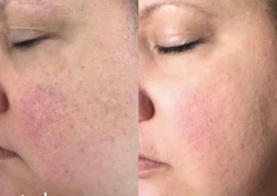 Lumecca before and after photo