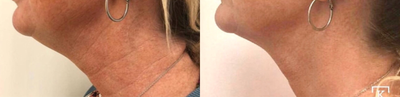 Botox before and after photo