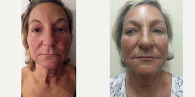 Botox before and after photo