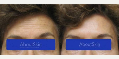 Botox before and after photo
