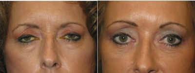 Brow Lift before and after photo