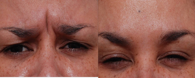 Dysport before and after photo