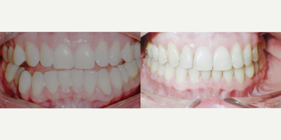 Jaw Surgery before and after photo