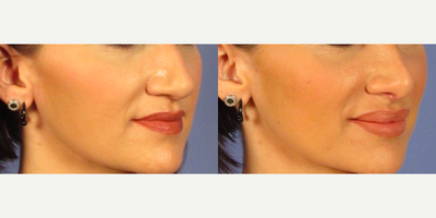 Lip Fillers before and after photo