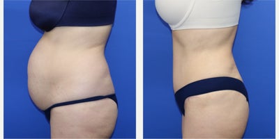Liposuction before and after photo