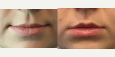Ultherapy before and after photo