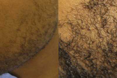 Beard Transplant before and after photo