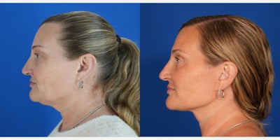 Deep Plane Facelift before and after photo