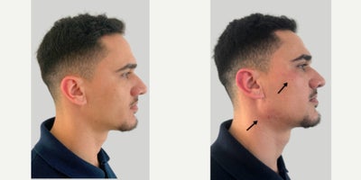 Dermal Fillers before and after photo