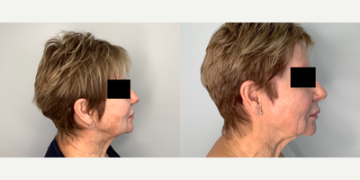 Halo Laser before and after photo