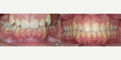 Invisalign before and after photo