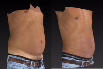 Liposuction before and after photo