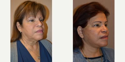 Neck Lift before and after photo