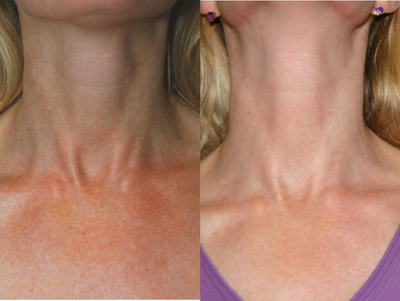 Vbeam before and after photo