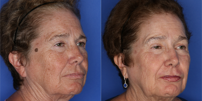 CO2 Laser before and after photo