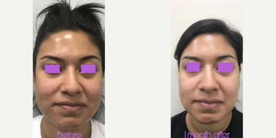 Facial before and after photo