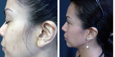 Laser Resurfacing before and after photo