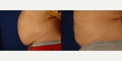 Liposuction before and after photo
