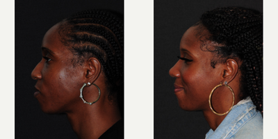 African American Rhinoplasty before and after photo