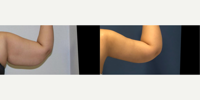 Arm Lift before and after photo