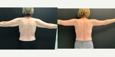 Arm Lift before and after photo