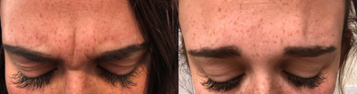 Botox before and after photo