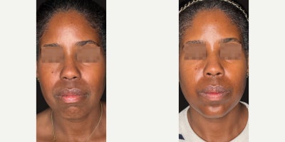 Botox before and after photo
