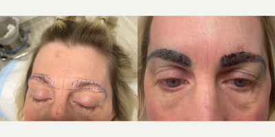 Eyebrow Transplant before and after photo