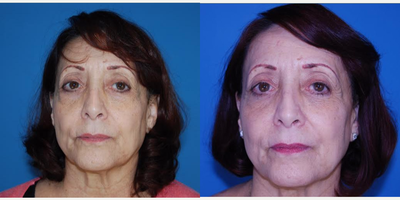 Eyelid Surgery before and after photo