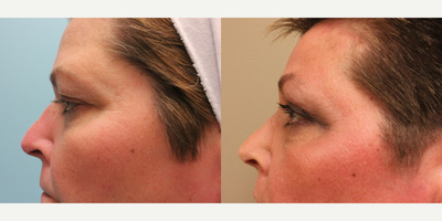 Eyelid Surgery before and after photo