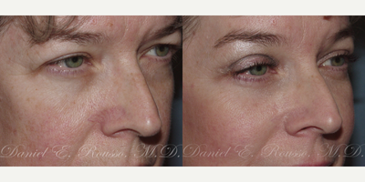 Eyelid Surgery before and after photo