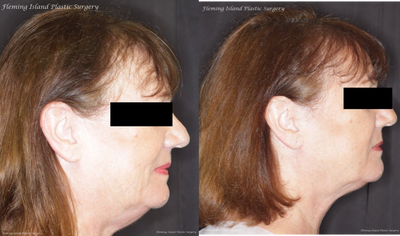 Renuvion before and after photo