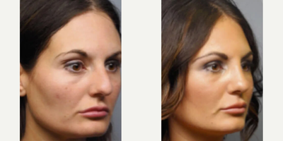 Rhinoplasty before and after photo