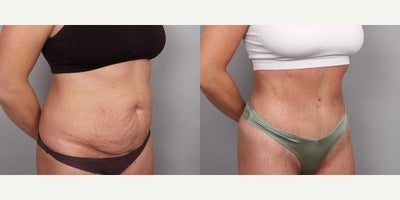 Tummy Tuck before and after photo