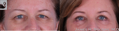 Eyelid Surgery before and after photo