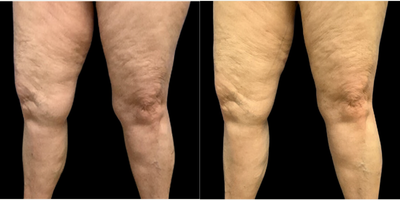 Liposuction before and after photo