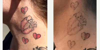 Tattoo Removal before and after photo