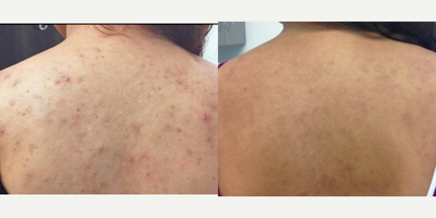 Accutane before and after photo