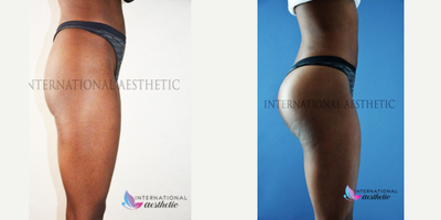 Butt Implants before and after photo