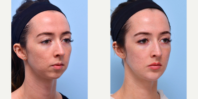 Dermal Fillers before and after photo