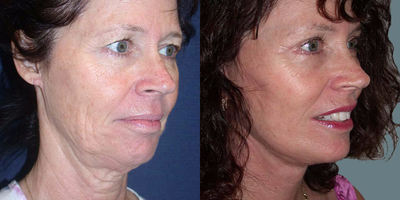 Facelift before and after photo