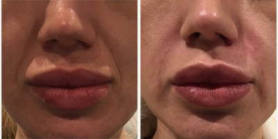 Juvederm before and after photo