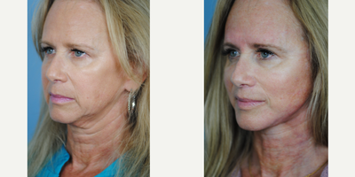 Lip Lift before and after photo